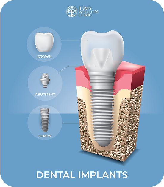 Dental Implants illustration